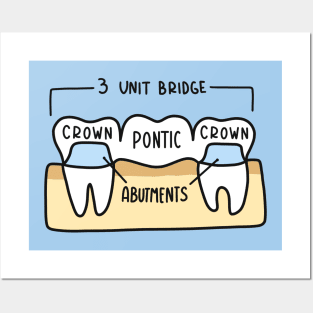 Hand Drawn Labeled Dental Bridge Posters and Art